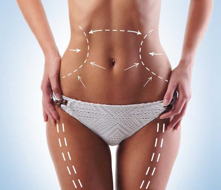 Liposuction