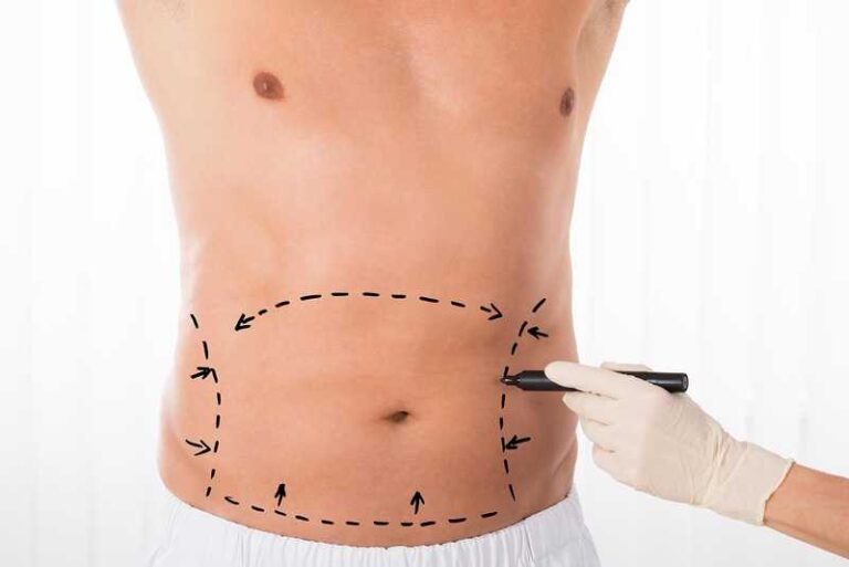 Vaser Liposuction