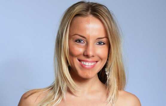 Facelift Surgery